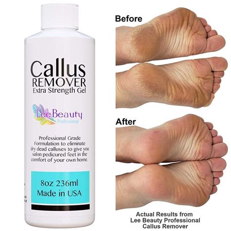 The ultimate foot care solution: magic callus remover gel